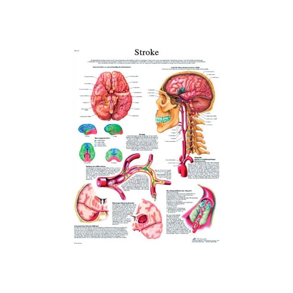 3B Anatomical Chart - Stroke Chart, Laminated